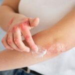 Estudio Revela Datos Críticos sobre Psoriasis en Puerto Rico