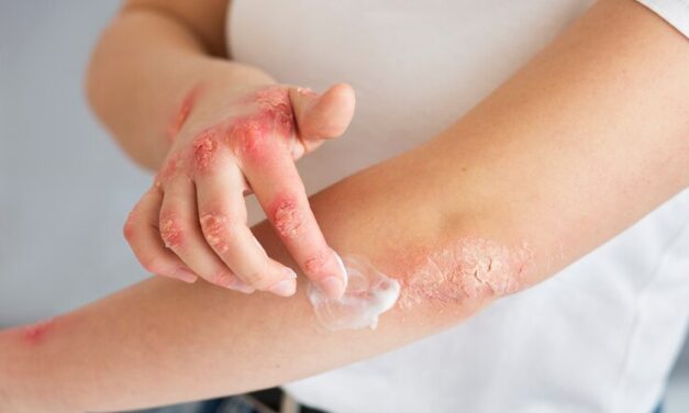 Estudio Revela Datos Críticos sobre Psoriasis en Puerto Rico