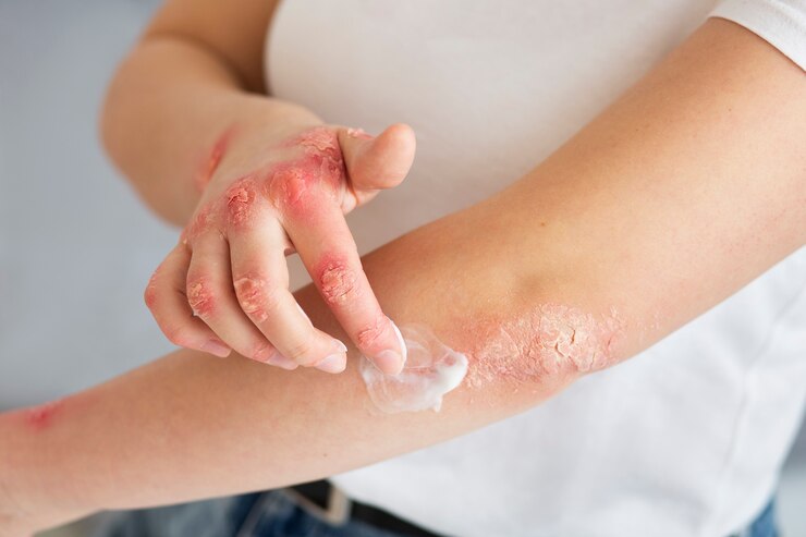 Estudio Revela Datos Críticos sobre Psoriasis en Puerto Rico