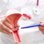 Centro Comprensivo de Cáncer invita a mujeres en Puerto Rico a participar en estudio clínico para mejorar estrategias para la prevención del cáncer cervical