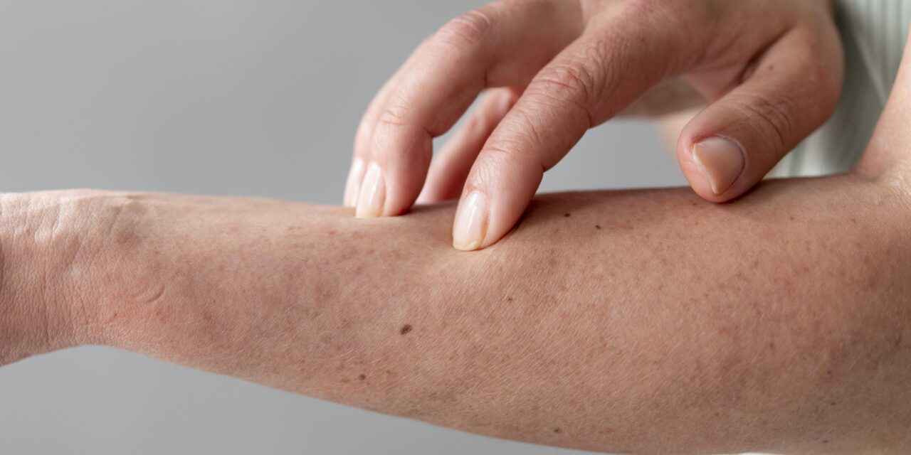 Los desencadenantes de la psoriasis en adolescentes y adultos jóvenes