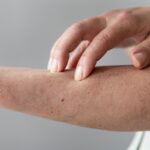 Los desencadenantes de la psoriasis en adolescentes y adultos jóvenes